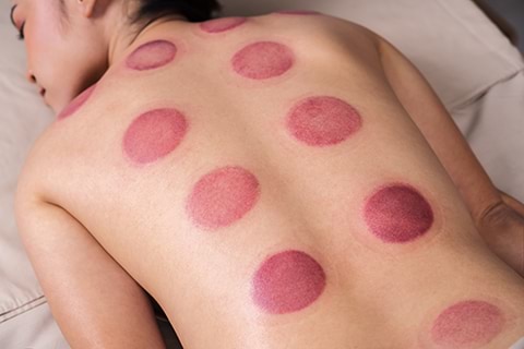 A woman laying on a bed with her back covered in round, pink, cupping spots on her skin.